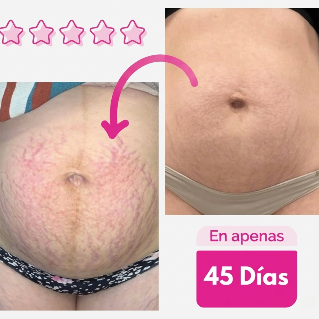 Antes y despues estrias 45 dias