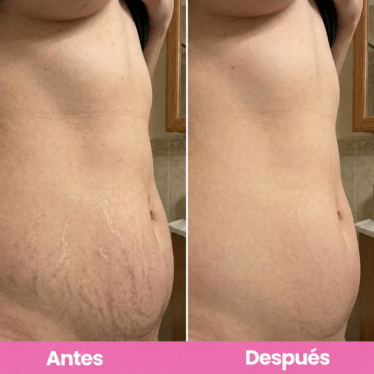 Antes y despues abdomen estrias