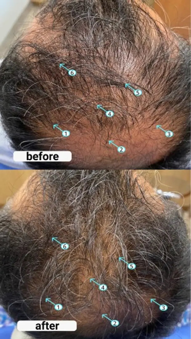 Resultados antes y despues - coronilla