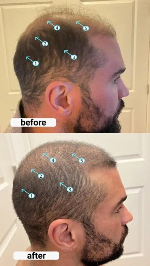 Resultados antes y despues - perfil lateral