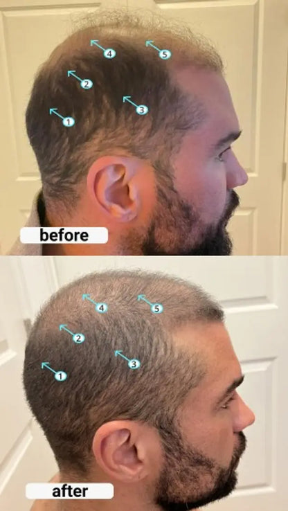 Resultados antes y despues - perfil lateral